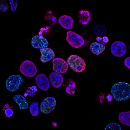 Photo of Human colorectal cancer cells